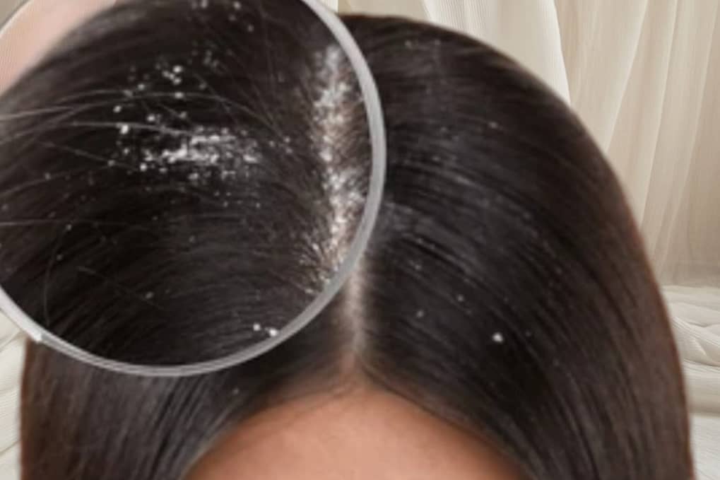 How to Get Rid of Dandruff Fast: Home Remedies That Actually Work